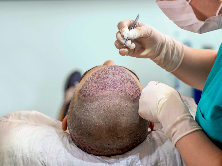 Hair-transplant-surgery-732x549-thumbanil